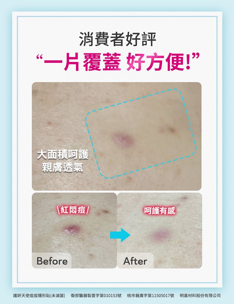 防水 透氣 護妍天使 水楊酸 防水 護妍天使