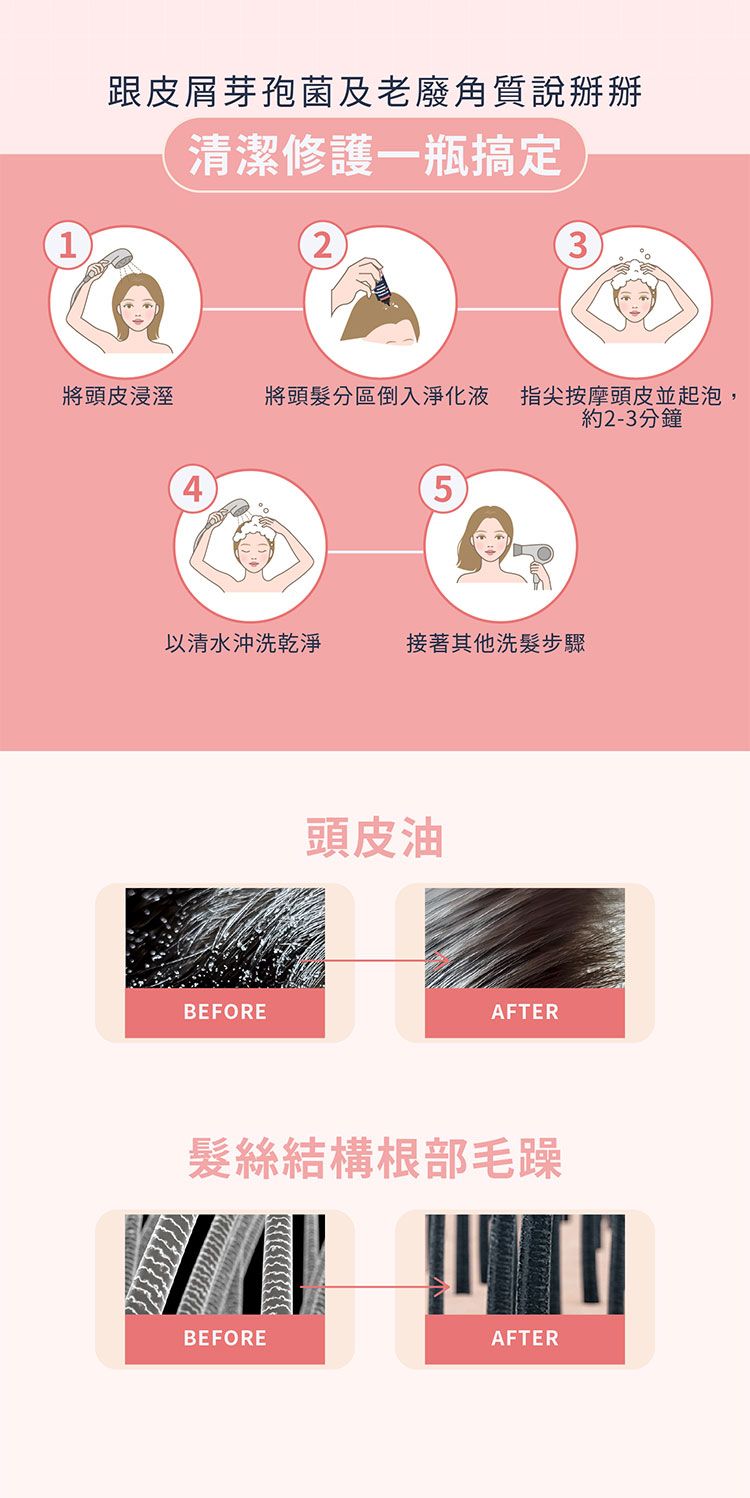 頭皮 去油 去屑 去油 頭皮 去屑
